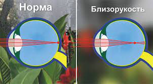 Что такое миопия и как ее лечить